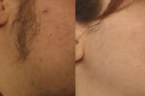 laser-hair-removal-custom